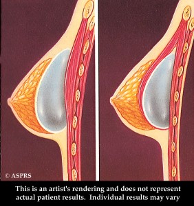 position implants breast seins